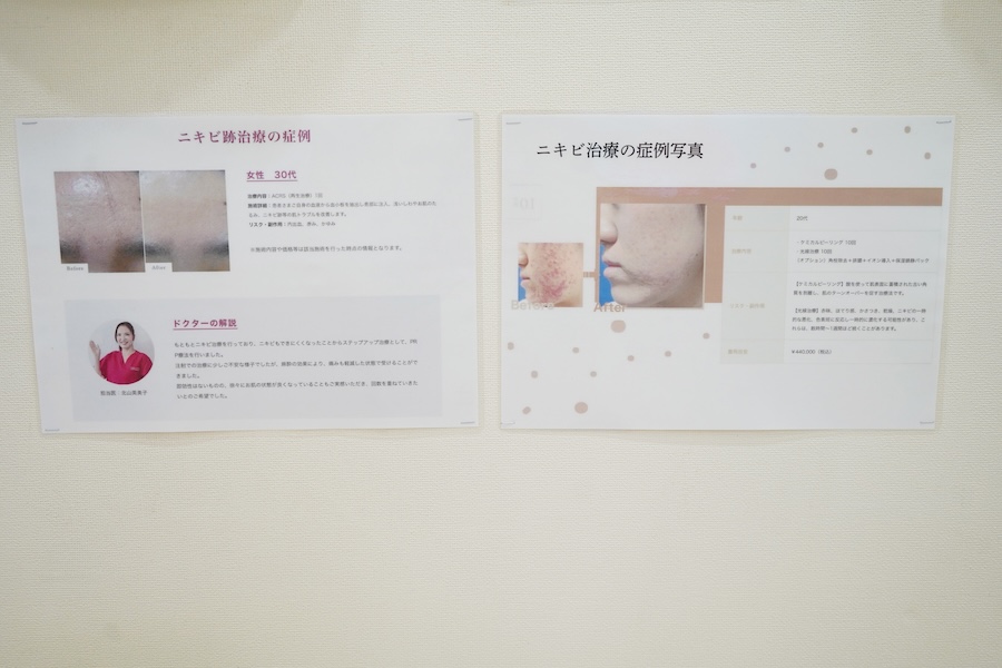 ニキビ治療の症例写真