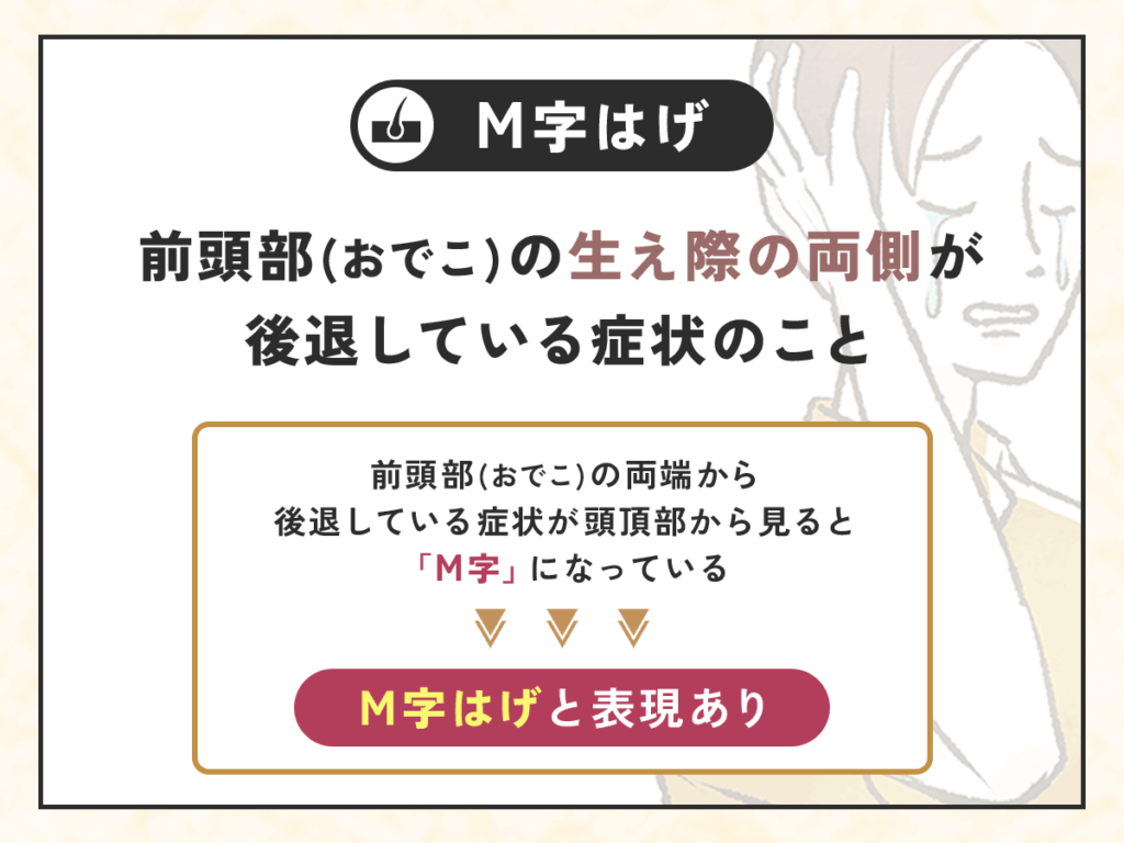 M字はげは前頭部（おでこ）の生え際の両側が後退していてAGAの進行疑惑