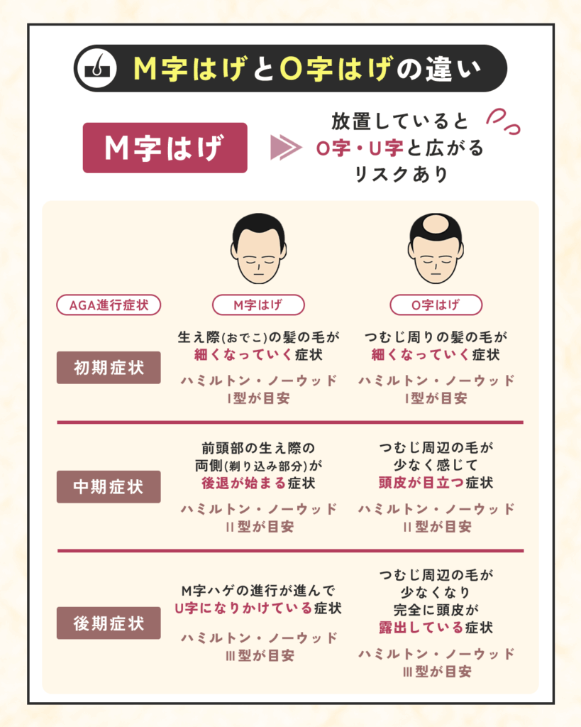 M字はげとO字・U字の違いを比較