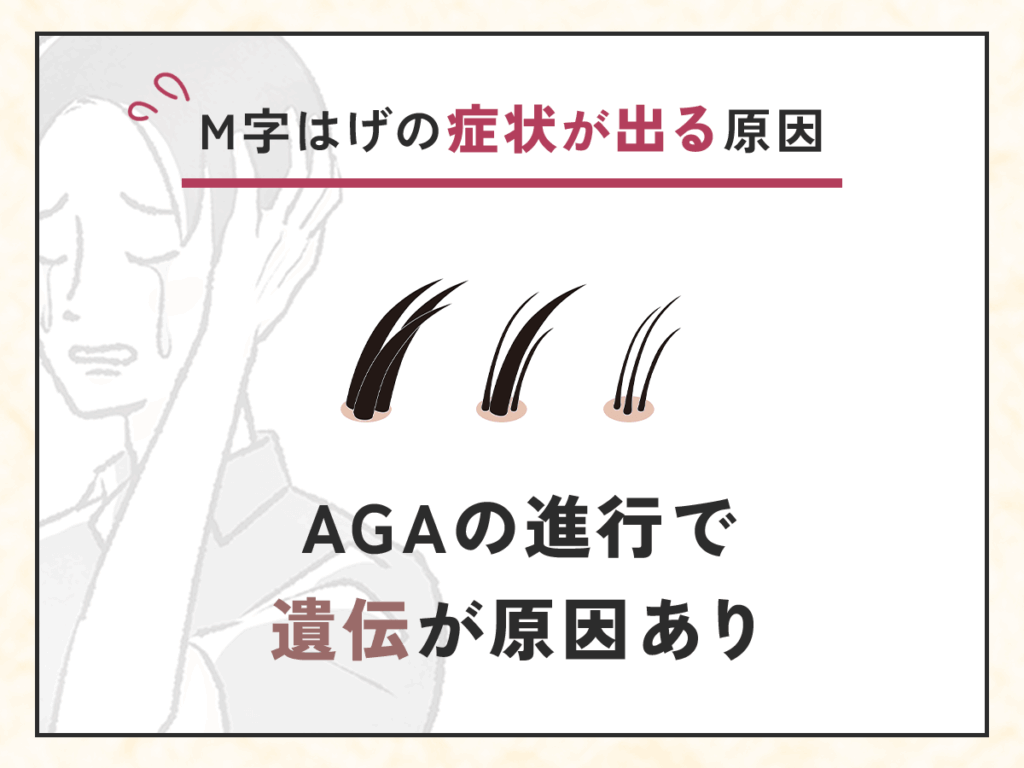 M字はげはAGAの進行で遺伝が原因あり